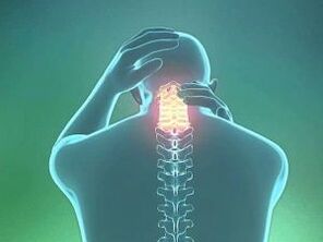 Симптомом шейного остеохондроза является головная боль. 