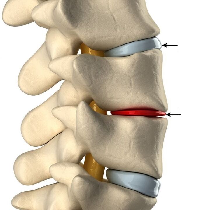 Отличие здорового диска от диска при остеохондрозе