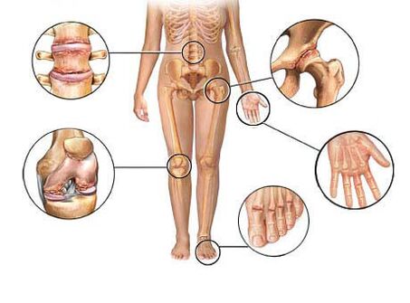 остеоартрит поражает несколько суставов